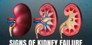 Signs of Kidney Dysfunction: Spotting Symptoms for Early Detection signs-of-kidney-dysfunction-spotting-symptoms-for-early-detection